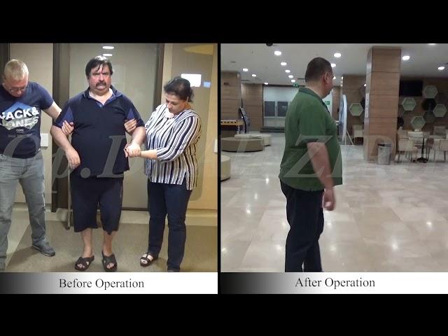 Ender KAVAS / Before and After Surgery Parkinson's Treatment DBS in Turkey