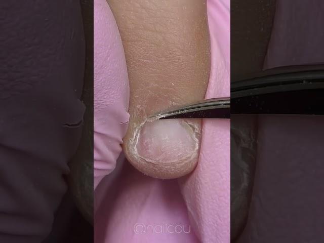 Uñas extremadamente mordidas: la manicura más desafiante de la historia