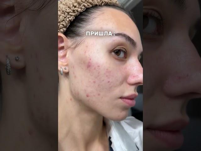ПОЧЕМУ НЕЛЬЗЯ ВЫДАВЛИВАТЬ ПРЫЩИ? #акне #косметологказань #прыщи