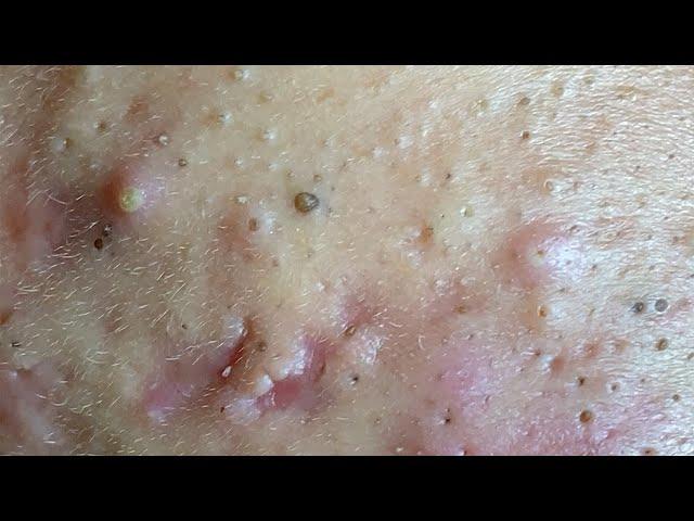 Make your Acne Treatment Huong Da Nang | 448# Hoang Part 1 | acne 2022