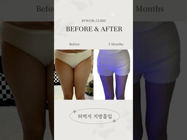 허벅지 지방흡입 리얼후기 #지방흡입후기
