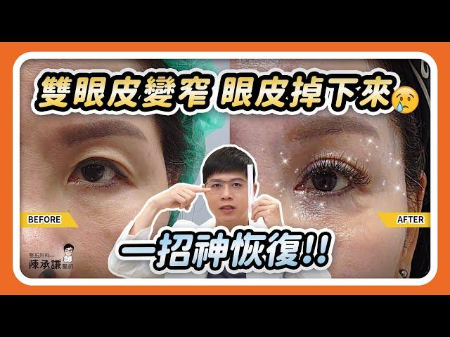 雙眼皮掉下來、越變越窄，告訴你割雙眼皮vs提眉哪個更有效！| 陳承謙醫師