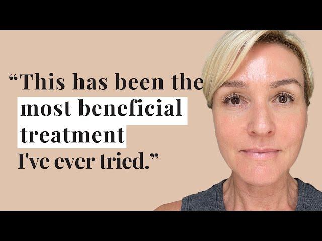 Morpheus8 Review: 12 Months Later — Facelift Without Surgery