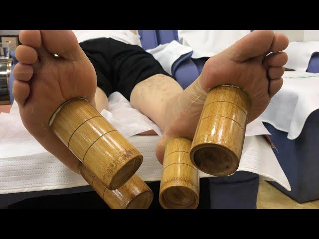 Chinese Traditional Foot Cupping  | Foot Cupping Techniques | 足カッピング| 발 컵 | قدم الحجامة