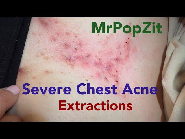 Large clogged pores emptied from chest area. Extraction techniques.Many curled ingrown hairs removed