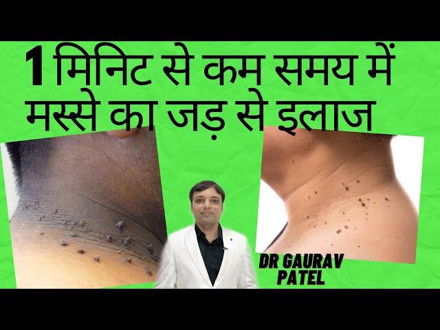 मस्से को जड़ से हटाने के उपाय | मस्से का जड़ से इलाज ।Treatment for skin tag removal |masse ka ilaj