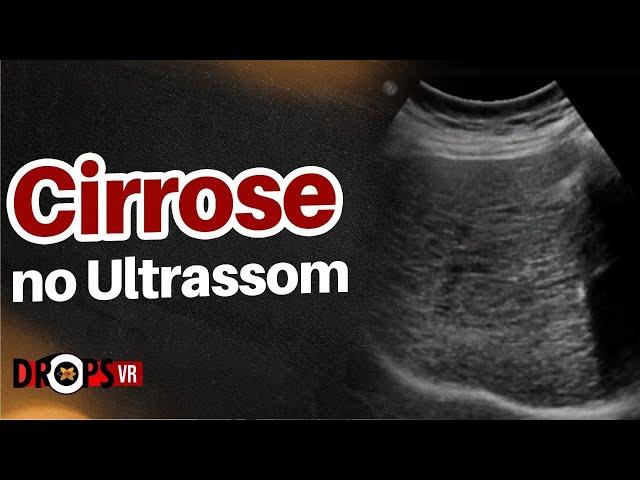 CIRROSE  - APRENDA A RECONHECER NO ULTRASSOM I VOCÊ RADIOLOGISTA