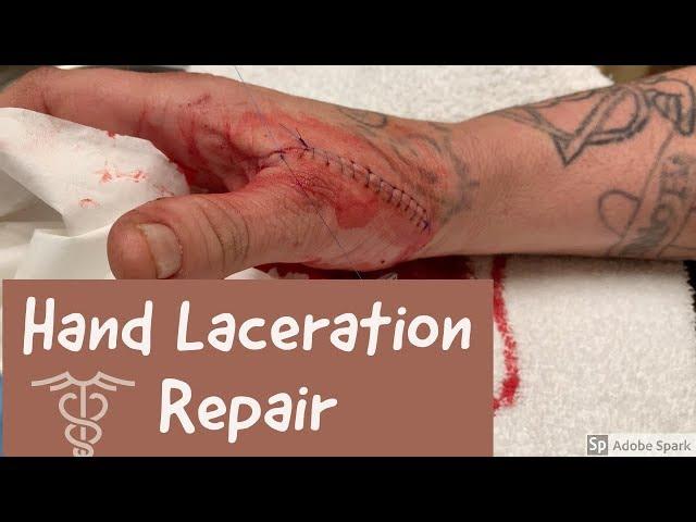 hand laceration repair