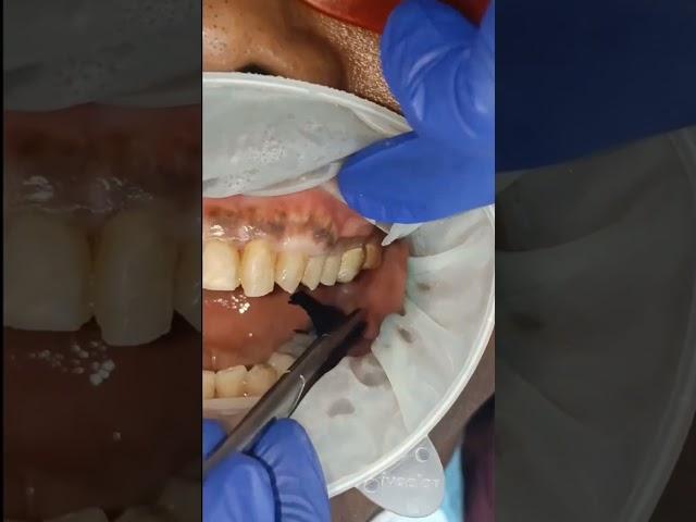 80 micron resistance test with baush articulating paper for lower molar implant bridge! ##shorts