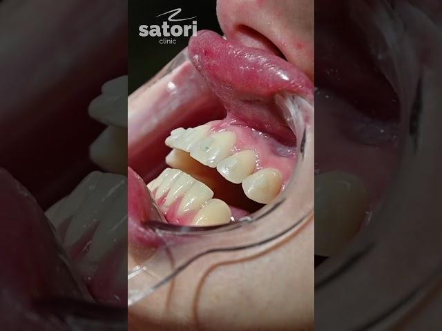 Элайнеры для исправления прикуса  #dentist #стоматология #braces