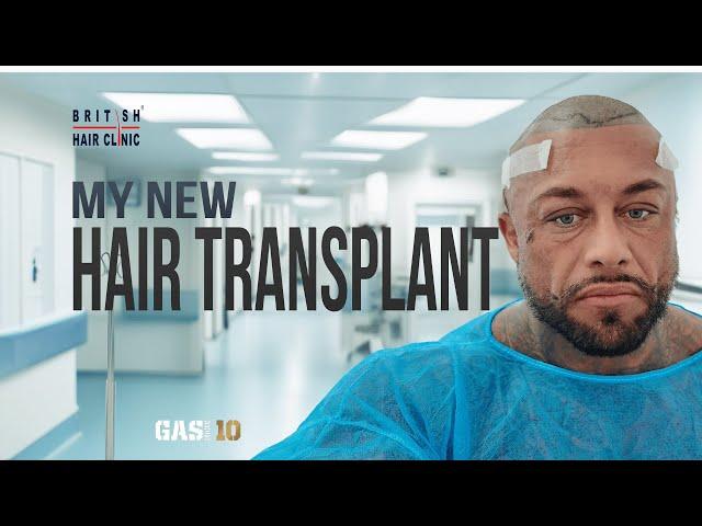 I GOT A HAIR TRANSPLANT | British Hair Clinic | Documenting The Journey