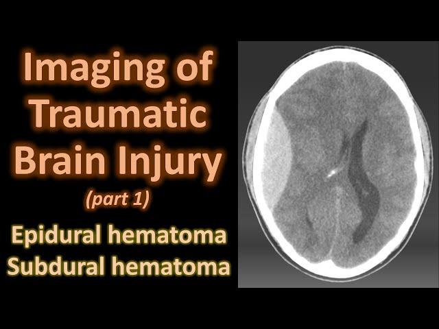 Imaging of Traumatic Brain Injury : Epidural and subdural hematoma