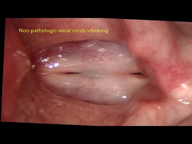 Mucus accumulation, Postnasal drip and the human voice