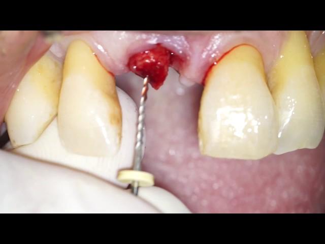Atraumatic Root Extraction by means of an endodontic file - Dr Fabio Cozzolino