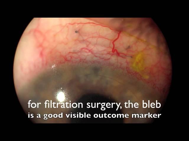 ophthaltimesepiscleral venous fluid wave and canal based surgery