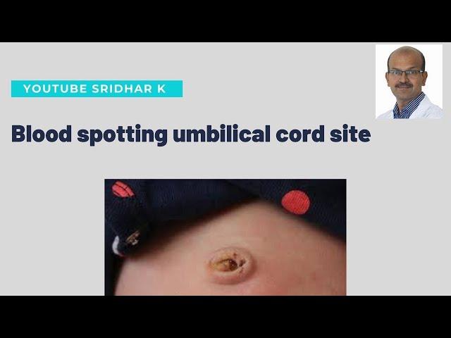 What to do if there is blood spotting at umbilical cord site. Dr Sridhar Kalyanasundaram