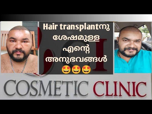 ആരും പേടിക്കണ്ട.ഇനി കഷണ്ടി...Hair Transplant ചെയ്തതിനുശേഷം ഉള്ള എന്റെ അനുഭവം... 