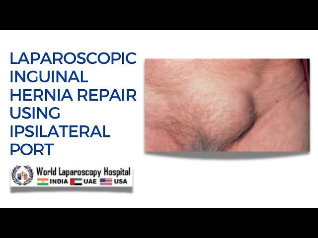 Laparoscopic TAPP Inguinal Hernia Repair Using Ipsilateral Port