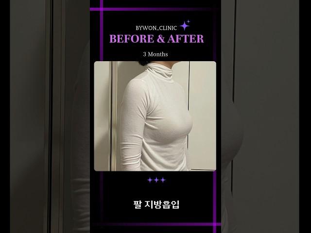 팔 지방흡입 #지방흡입후기