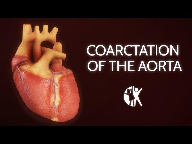 Coarctation of the Aorta