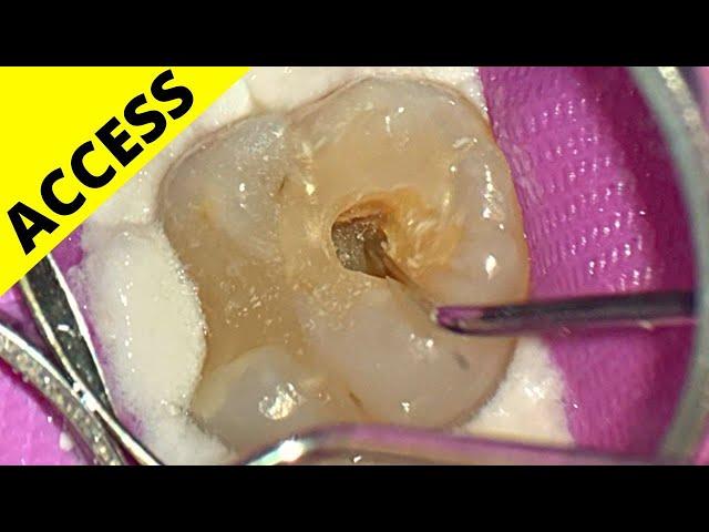 MAX MOLAR ACCESS (Ep.1 of Whole Case)