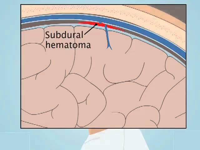 Understanding Subdural Hematoma