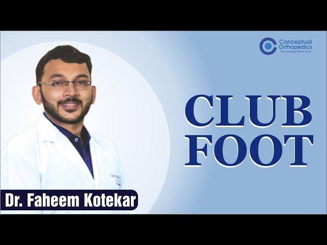 Club Foot by Dr. Faheem kotekar @Conceptual Orthopedics