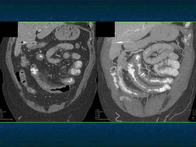 Abdominal Pain in the ER: GI Pathology - Part 1