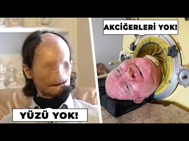 Bazı Organları Eksik Olan 10 İnanılmaz İnsan!