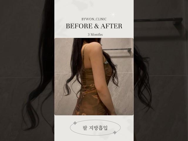 팔 지방흡입 리얼후기 #지방흡입