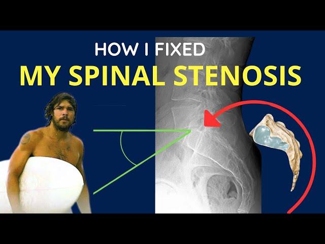 How I Reversed Spinal Stenosis without Surgery