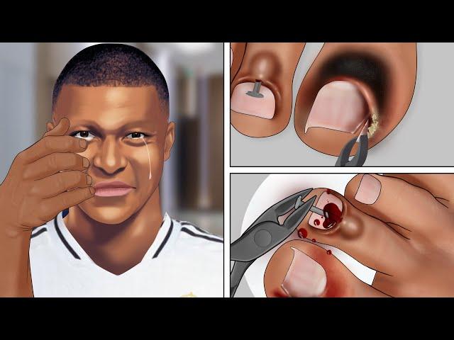 [ASMR] Help Kylian Mbappé Remove iron nails stuck in toenail