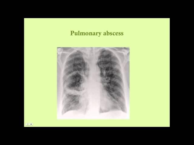 Pulmonary Infections - CRASH! Medical Review Series