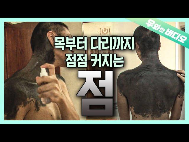 Growing Giant Mole from Neck to Legs