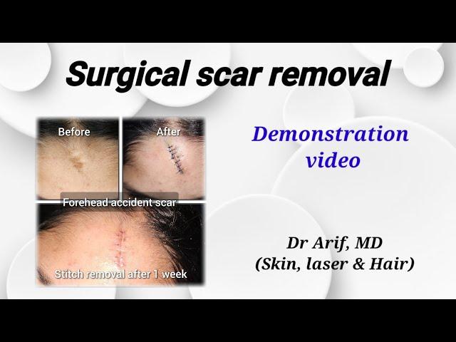 Surgical scar removal @DrArifMDDermatologist #scarsurgery #scartreatment #scar