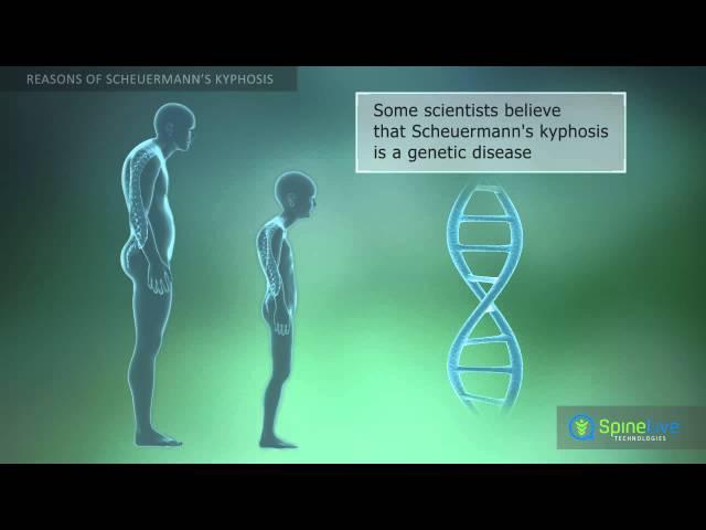 Scheuermann’s kyphosis Reasons