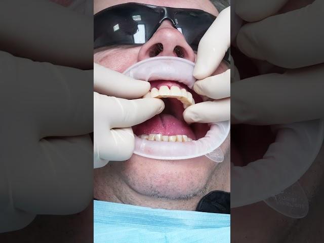 Dental implant’s All on 4 in Prague #shorts #dentist #dental #implant #veneers #short
