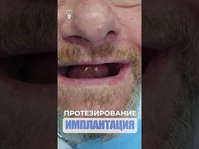 Протезирование и имплантация. Implantation.