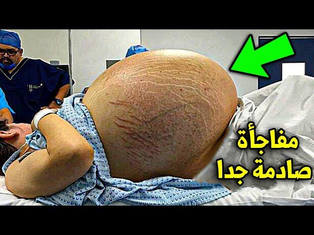هذه المرأة اعتقدت انها حامل بتوأم ، لكن ما وجده الطبيب في بطنها صدم الجميع !