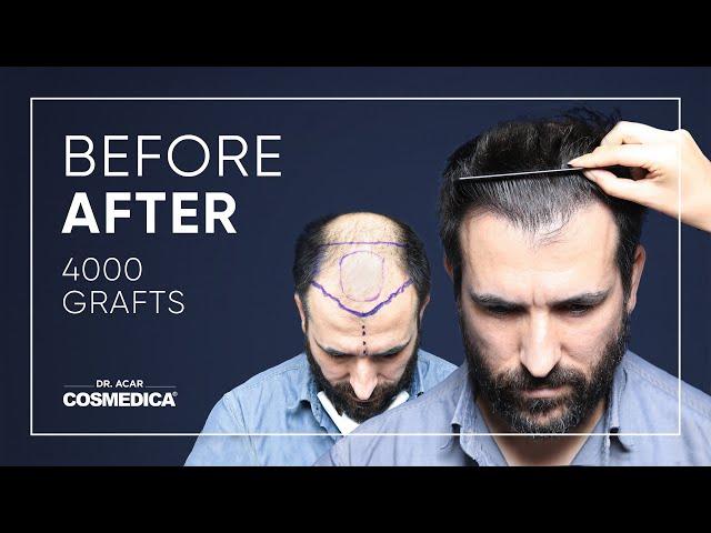 Hair Transplant in Turkey | Results | Dr. Acar | Cosmedica Clinic