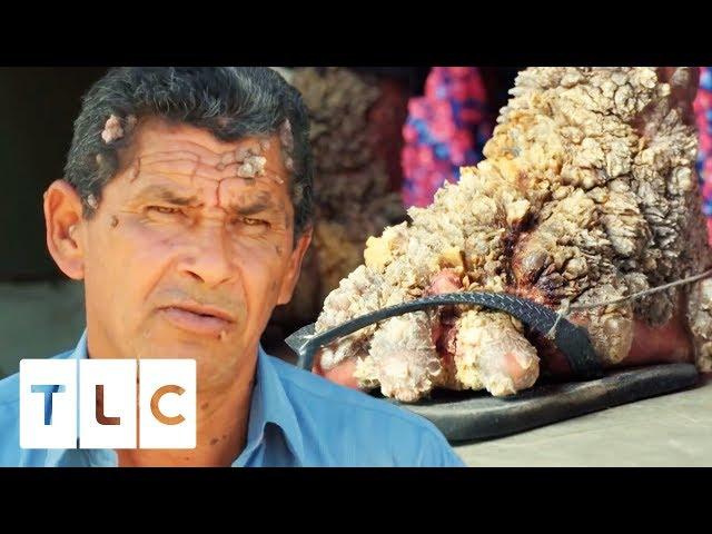 Luis Has Spent 40 Years Living With Extreme Viral Warts | Body Bizarre