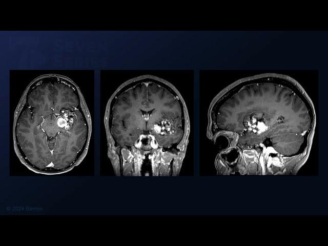 Transsylvian-Transinsular Resection of a Giant Putaminal Basal Ganglia Cavernous Malformation