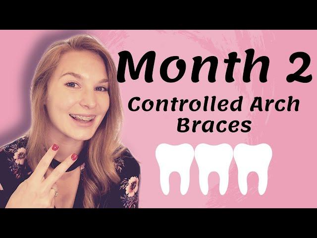 Month 2 Braces Update | Controlled Arch Braces