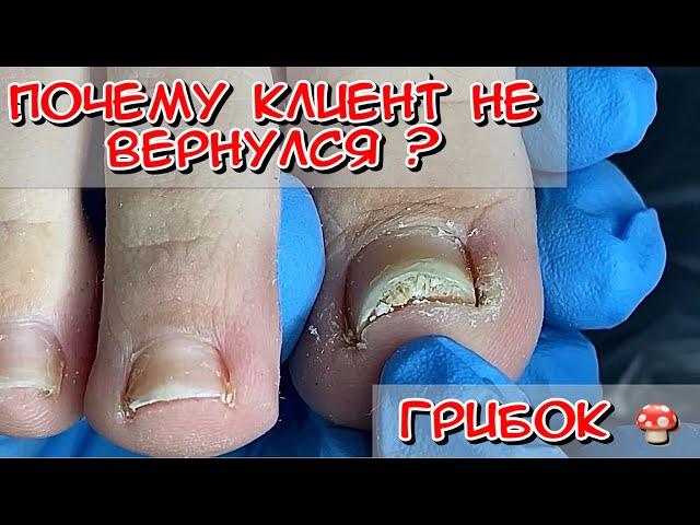 ПОЧЕМУ КЛИЕНТ НЕ ВЕРНУЛСЯ? ГРИБОК НОГТЕЙ /ОТКУДА ГРИБОК? СКРУЧЕННЫЙ НОГОТЬ / ОНИХОЛИЗИС / ОНИХОМИКОЗ