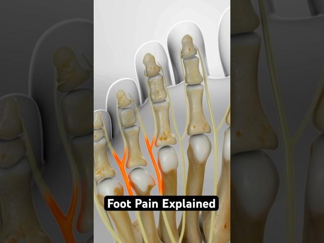 What is causing your foot pain? (3D Animation)