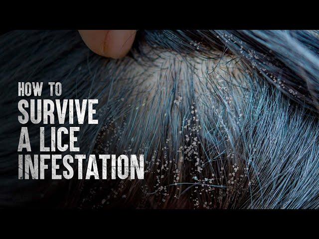 How to Survive a Lice Infestation