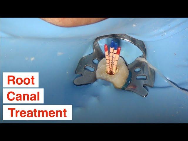 Root Canal Treatment