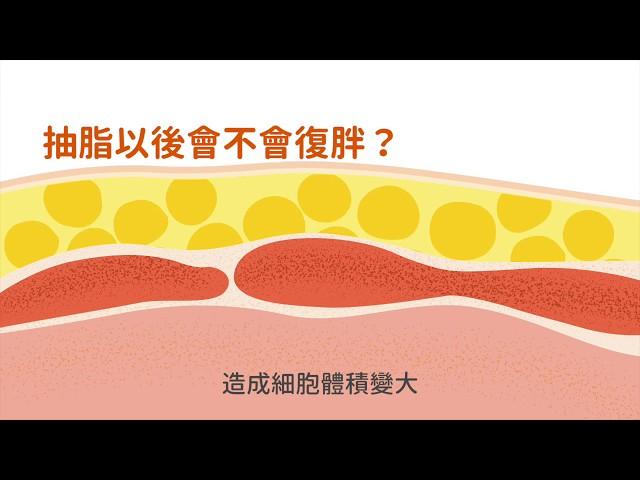 威塑抽脂術後會復胖嗎？│抽脂術後保養│群英整形小百科