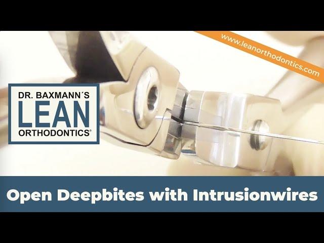 Open Deepbites with Intrusionwires #shorts