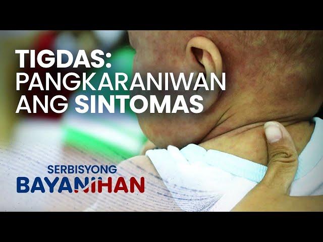 Gaano kabilis makahawa ang tigdas o ilang araw bago lumabas ang sintomas?